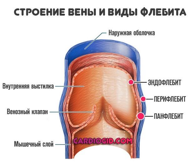 Вены Хрупкие