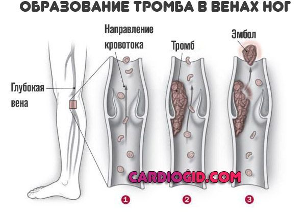 Тянет вену на ноге. Тянет вены при температуре.