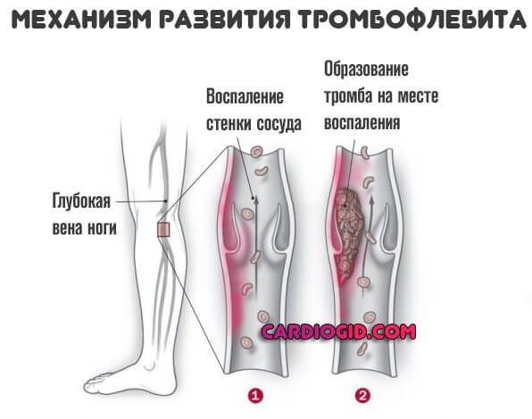 Тромбофлебит нижних конечностей лечение препараты схема лечения глубоких вен нижних конечностей