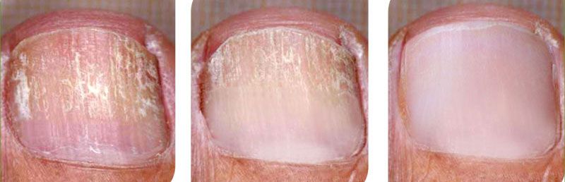 Как выглядит грибок ногтей на ногах - Симптомы и лечение болезней
