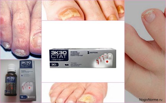 Экзостат от грибка ногтей отзывы - Симптомы и лечение болезней
