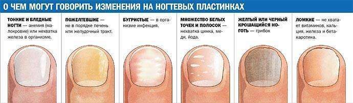 Как выглядит грибок ногтей на ногах фото - Симптомы и лечение болезней