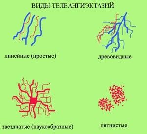 Чем лечить сосуды на плечах