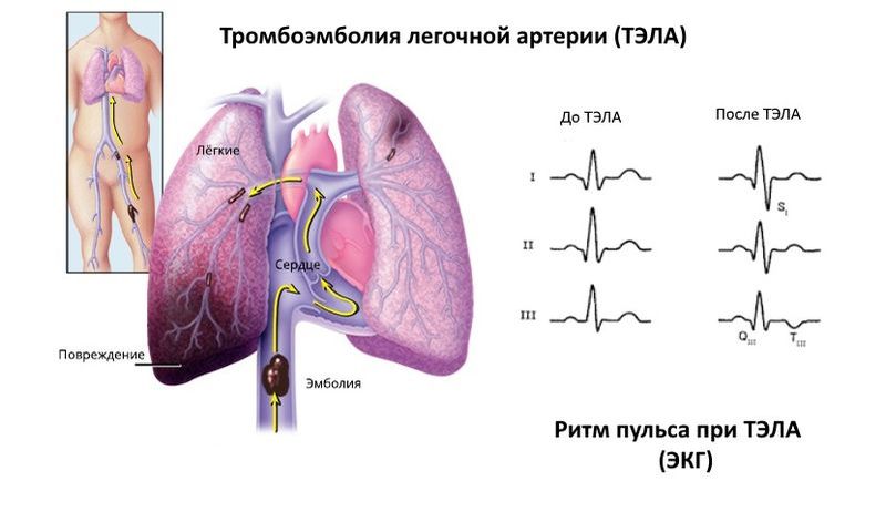 Тромбоэмболия сердечная